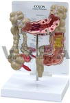   Colon Anatomy Model w/ common pathologies